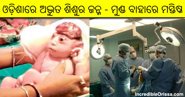Odisha: Baby born with brain outside his skull amazes doctors