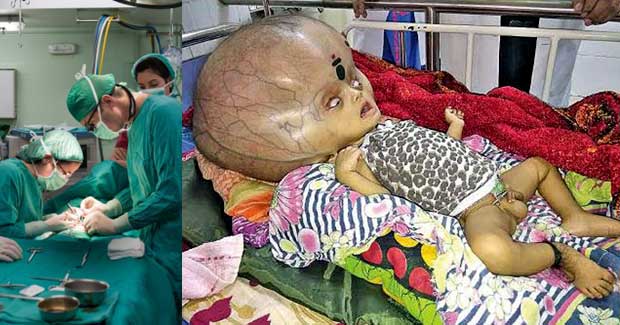 Odisha baby with a giant head is among the world’s largest