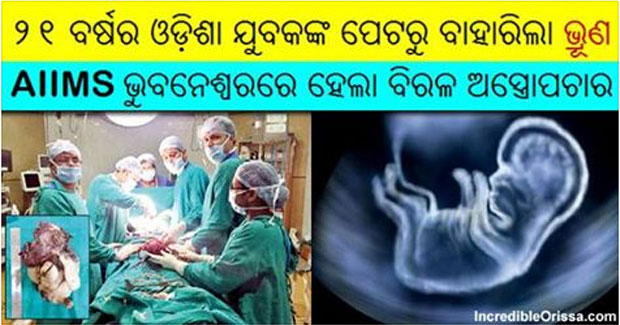 Foetus from boy’s stomach removed by surgery in AIIMS Bhubaneswar