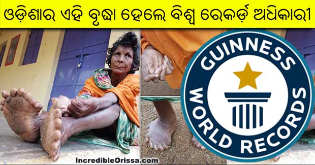 Odisha woman with 19 toes and 12 fingers sets Guinness world record